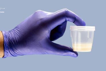 Semen Analysis in Hyderabad